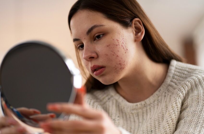 Acne tardia desafia mulheres adultas com lesões persistentes e dolorosas