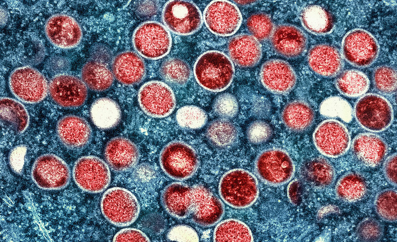  Secretaria da Saúde da Paraíba investiga suspeita de MPOX em turista do RN