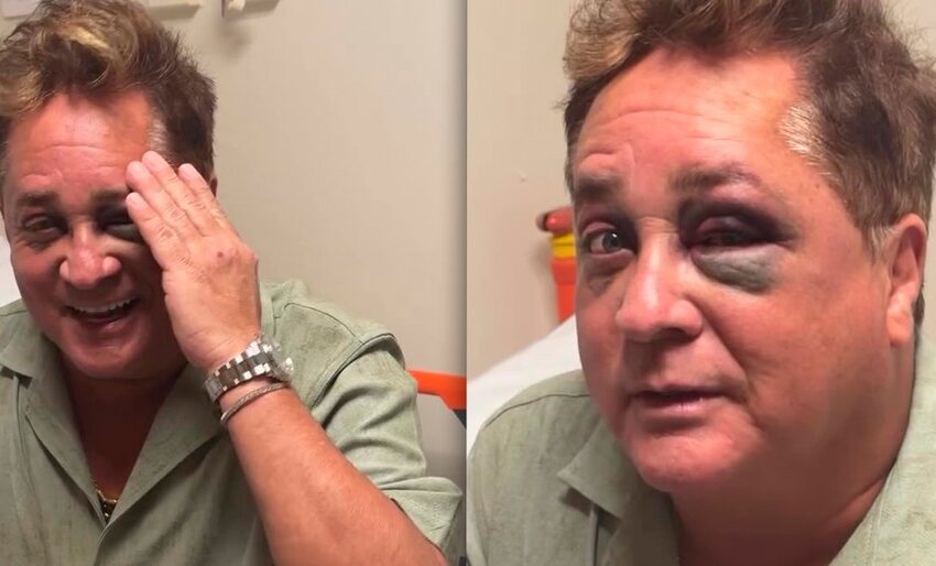  Leonardo sofre acidente em pescaria no Pantanal e aparece com olho roxo; Cantor brinca: “Não canto com os olhos”